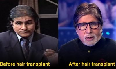 5 Bollywood Celebrities Whose Career Changed After Getting Hair Transplant