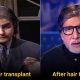 5 Bollywood Celebrities Whose Career Changed After Getting Hair Transplant