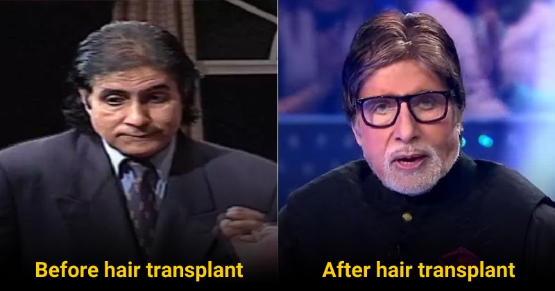 5 Bollywood Celebrities Whose Career Changed After Getting Hair Transplant